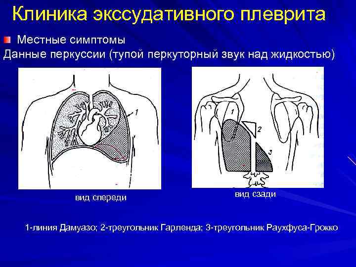 Экссудативный плеврит карта вызова скорой медицинской