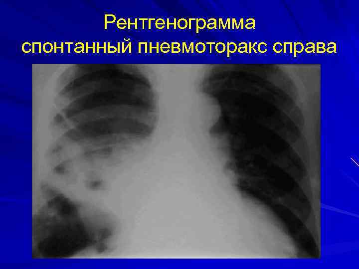 Рентген картина пневмоторакса