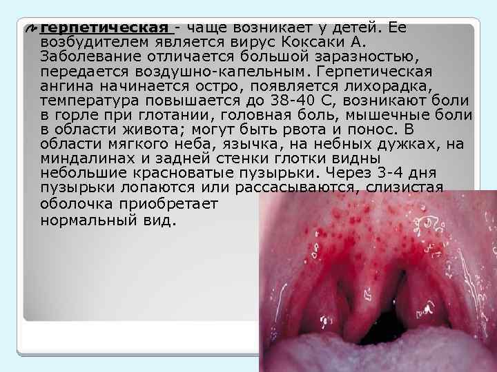 герпетическая - чаще возникает у детей. Ее возбудителем является вирус Коксаки А. Заболевание отличается