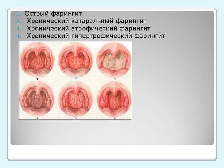 1. 2. 3. 4. Острый фарингит Хронический катаральный фарингит Хронический атрофический фарингит Хронический гипертрофический