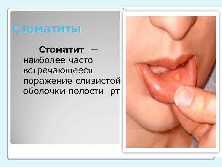 Стоматиты Стоматит — наиболее часто встречающееся поражение слизистой оболочки полости рта. 