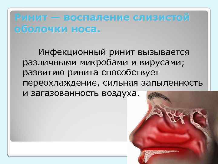 Ринит — воспаление слизистой оболочки носа. Инфекционный ринит вызывается различными микробами и вирусами; развитию