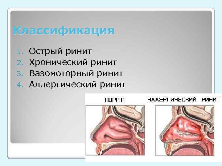 Классификация Острый ринит 2. Хронический ринит 3. Вазомоторный ринит 4. Аллергический ринит 1. 