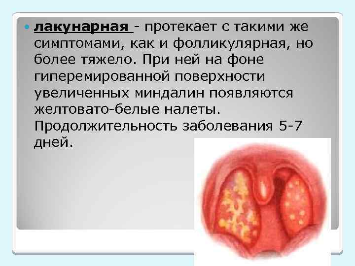  лакунарная - протекает с такими же симптомами, как и фолликулярная, но более тяжело.