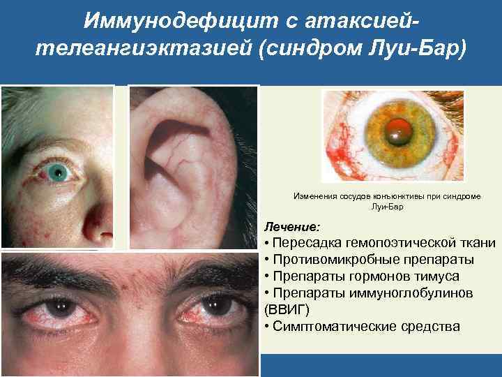 Иммунодефицит с атаксиейтелеангиэктазией (синдром Луи-Бар) Изменения сосудов конъюнктивы при синдроме Луи-Бар Лечение: • Пересадка