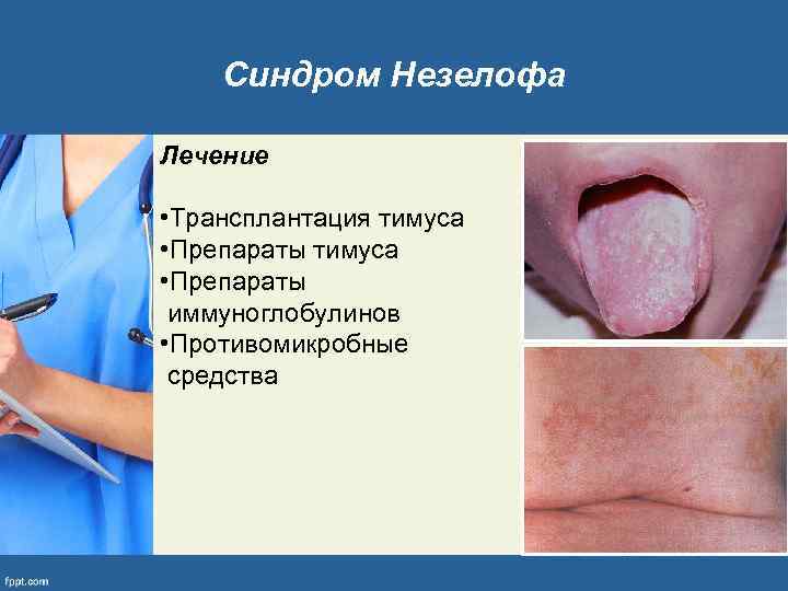 Синдром Незелофа Лечение • Трансплантация тимуса • Препараты иммуноглобулинов • Противомикробные средства 