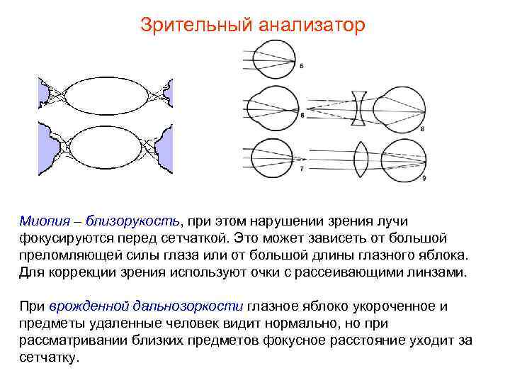 Зрительный анализатор Миопия – близорукость, при этом нарушении зрения лучи фокусируются перед сетчаткой. Это