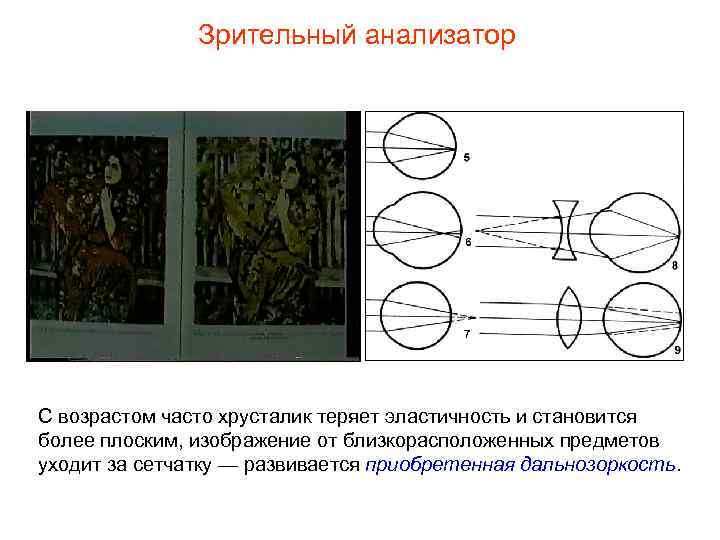 Зрительный анализатор С возрастом часто хрусталик теряет эластичность и становится более плоским, изображение от