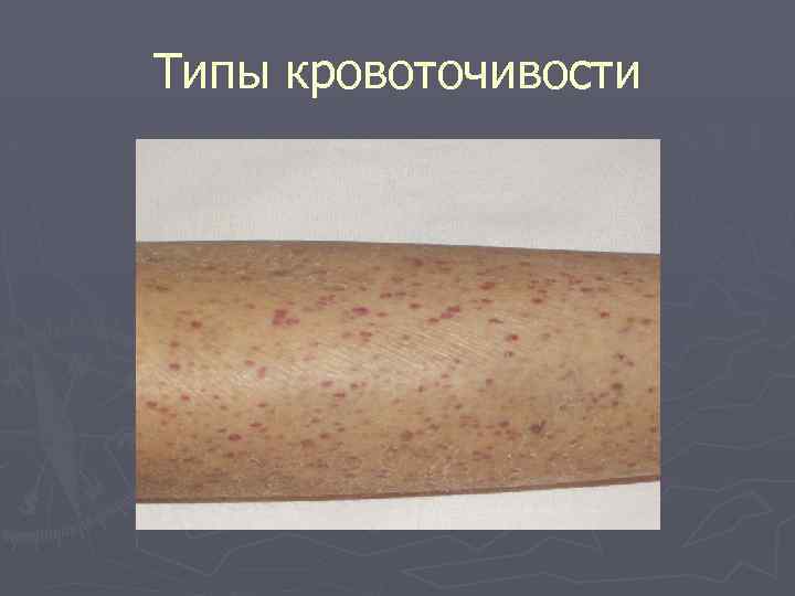 Типы кровоточивости 