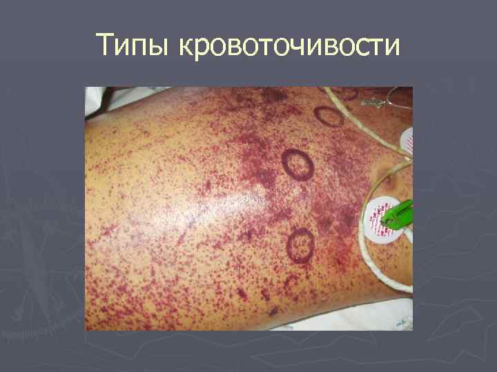 Типы кровоточивости 