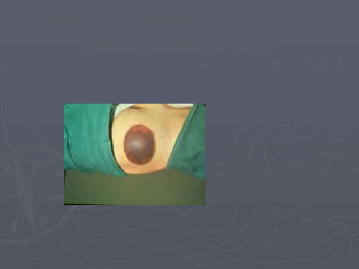 Клиника гемофилии А (ГА) и гемофилии В (ГВ) 