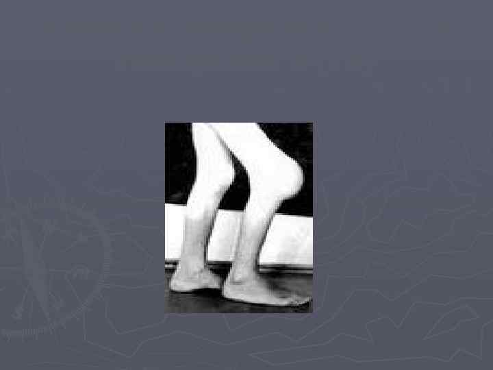 Клиника гемофилии А (ГА) и гемофилии В (ГВ) 