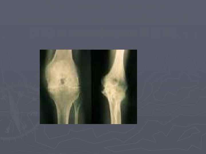 Рентгенологические изменения при гемофилии А (ГА) и гемофилии В (ГВ) 