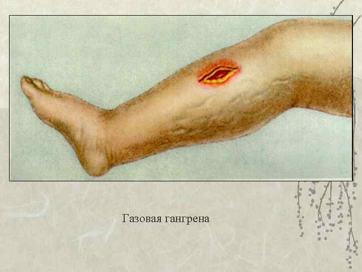 Газовая гангрена 