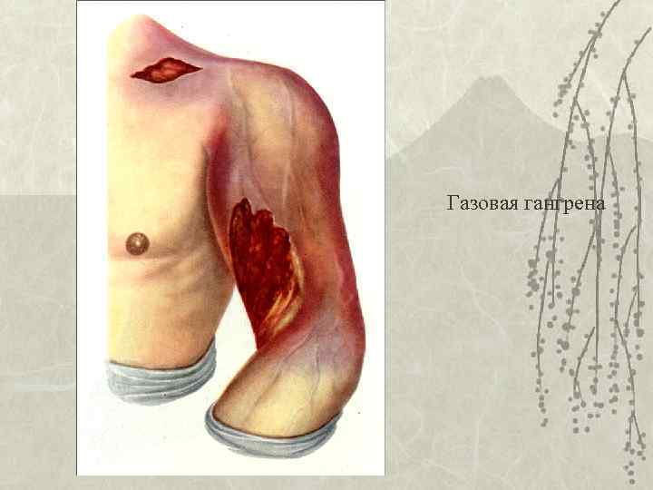 Газовая гангрена 