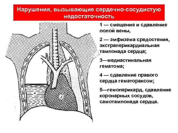 Нарушения, вызывающие сердечно-сосудистую недостаточность 1 — смещение и сдавление полой вены, 2 — эмфизема
