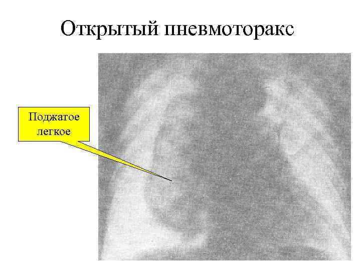 Открытый пневмоторакс Поджатое легкое 