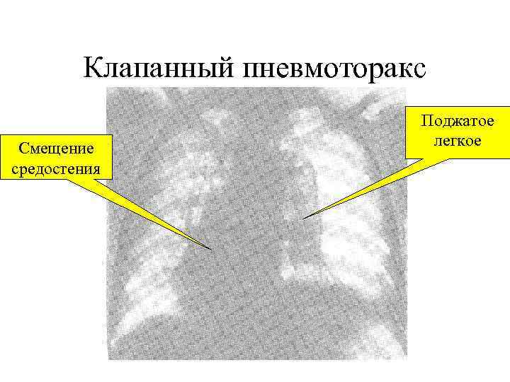 Клапанный пневмоторакс Смещение средостения Поджатое легкое 