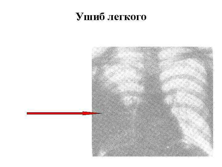 Ушиб легкого 
