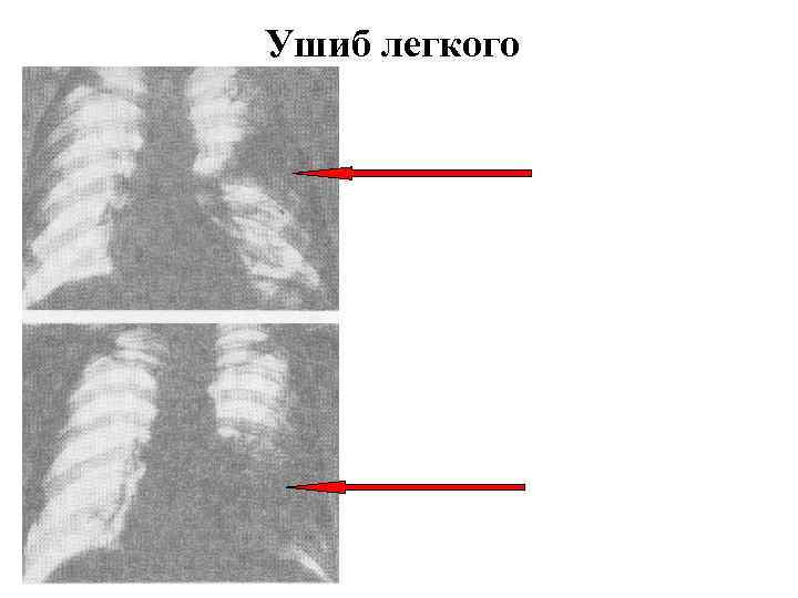 Ушиб легкого 