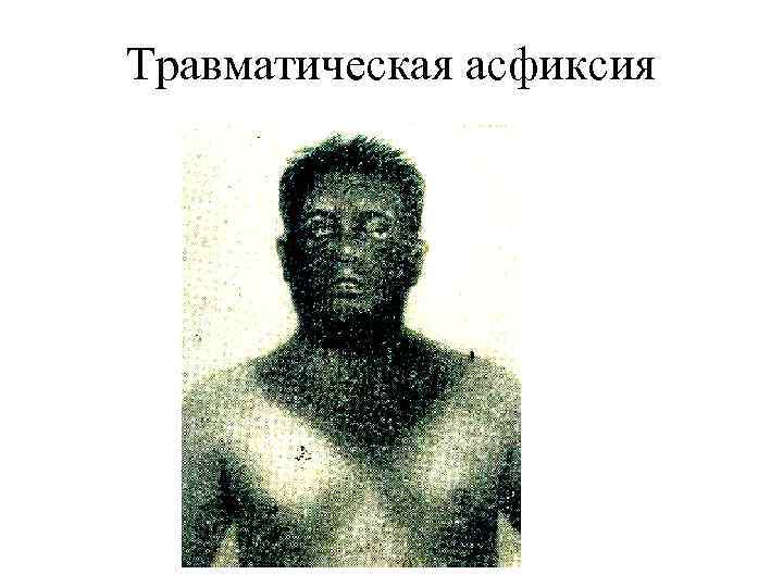 Травматическая асфиксия 