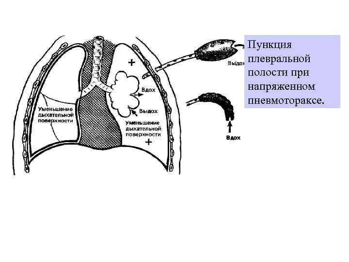Пункция плевральной полости при напряженном пневмотораксе. 