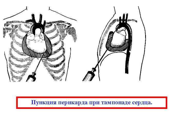 Пункция перикарда при тампонаде сердца. 