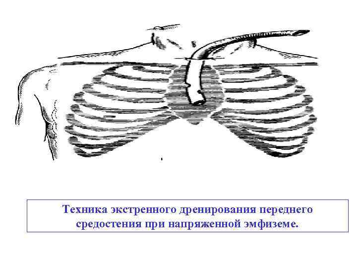 Техника экстренного дренирования переднего средостения при напряженной эмфиземе. 