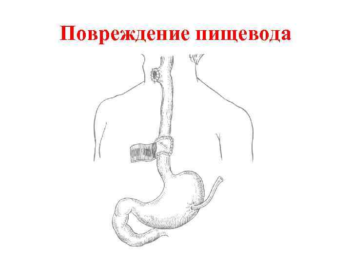 Повреждение пищевода 