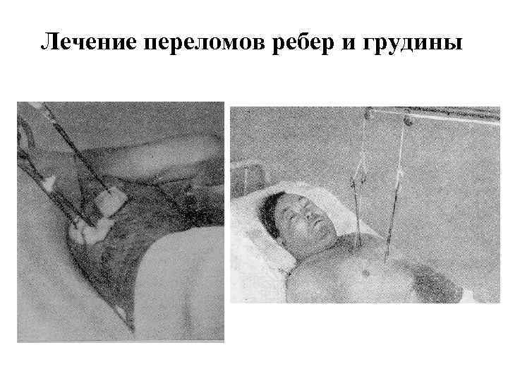 Лечение переломов ребер и грудины 