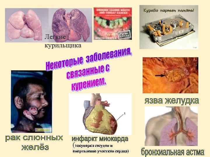 Легкие курильщика (закупорка сосудов и омертвление участков сердца) 