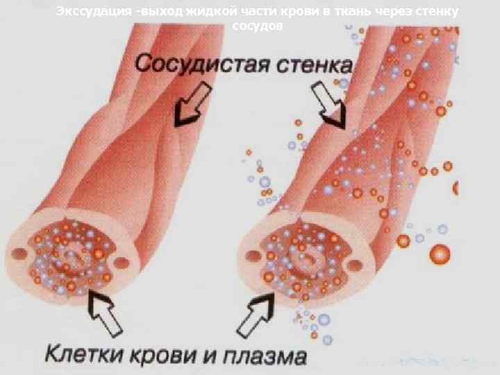 Экссудация -выход жидкой части крови в ткань через стенку сосудов 