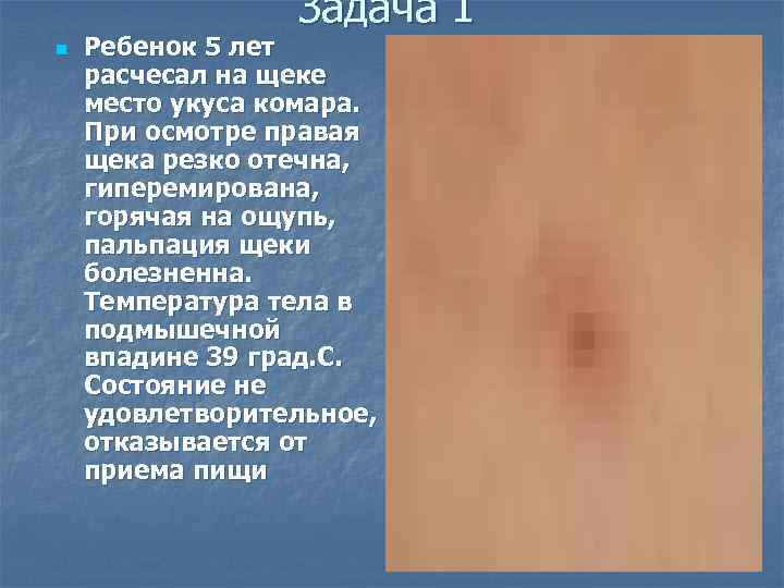 Задача 1 n Ребенок 5 лет расчесал на щеке место укуса комара. При осмотре