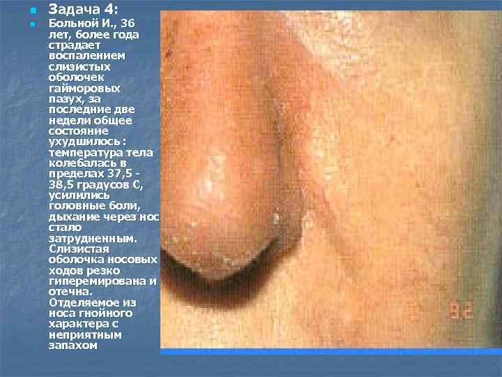 n n Задача 4: Больной И. , 36 лет, более года страдает воспалением слизистых