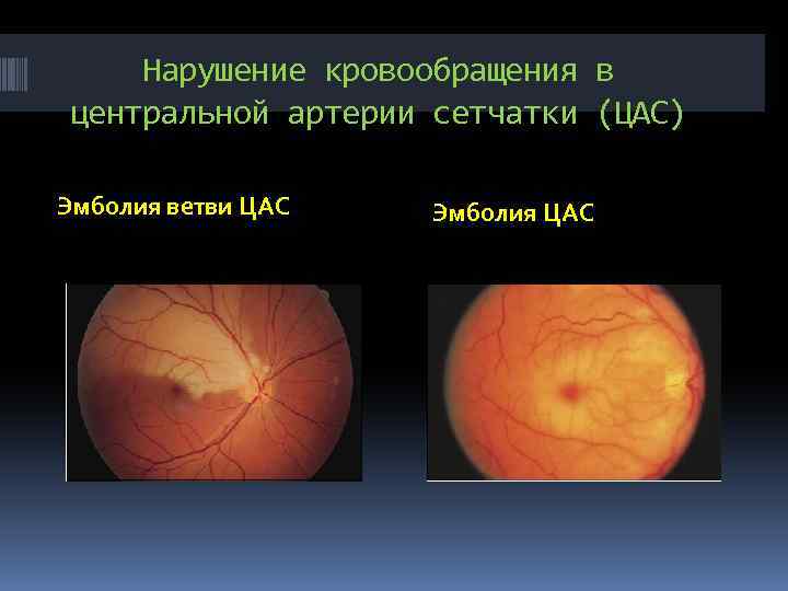 Нарушение кровообращения в центральной артерии сетчатки (ЦАС) Эмболия ветви ЦАС Эмболия ЦАС 