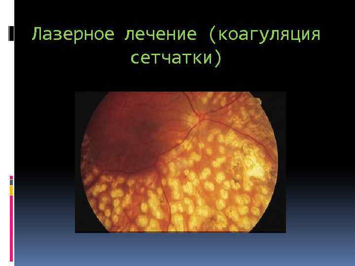 Лазерное лечение (коагуляция сетчатки) 