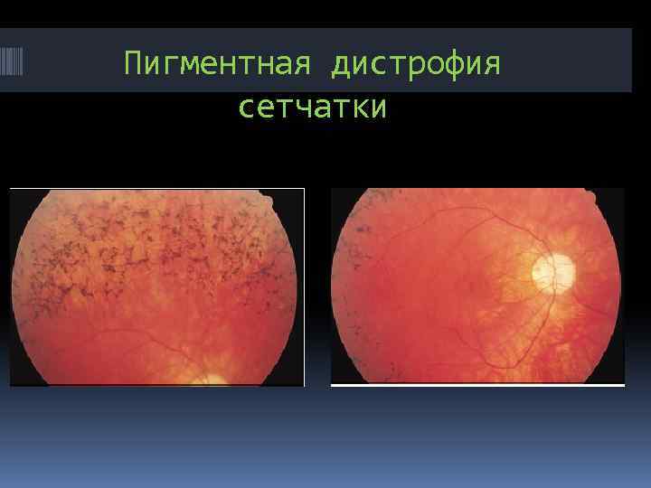 Пигментная дистрофия сетчатки 