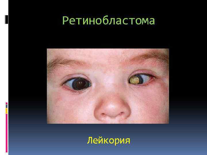 Ретинобластома Лейкория 