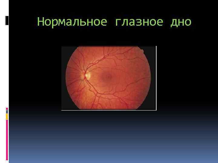 Нормальное глазное дно 