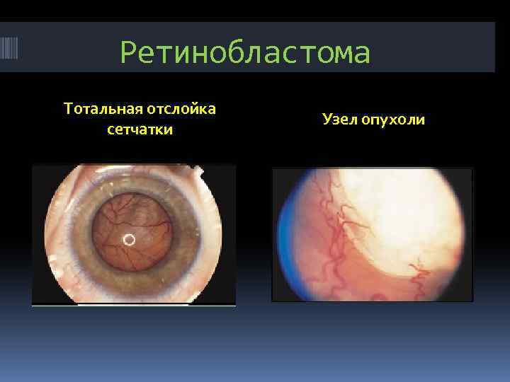Ретинобластома Тотальная отслойка сетчатки Узел опухоли 