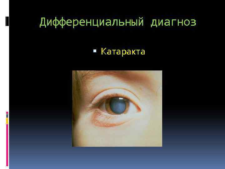 Дифференциальный диагноз Катаракта 