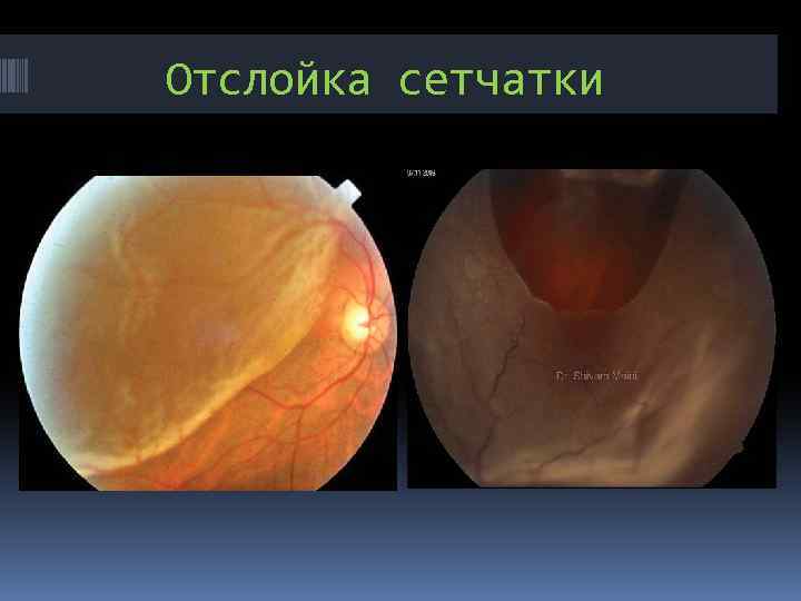 Отслойка сетчатки 
