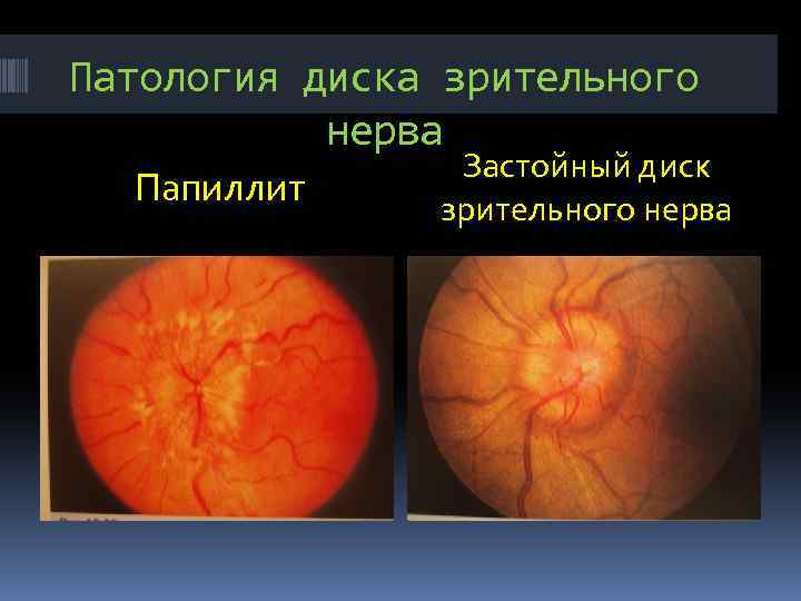 Аномалия развития зрительного нерва. Папиллит диска зрительного нерва. Застойный диск зрительного нерва дифференциальная диагностика. Интрабульбарный неврит зрительного нерва. Ретробульбарный неврит глазное дно.