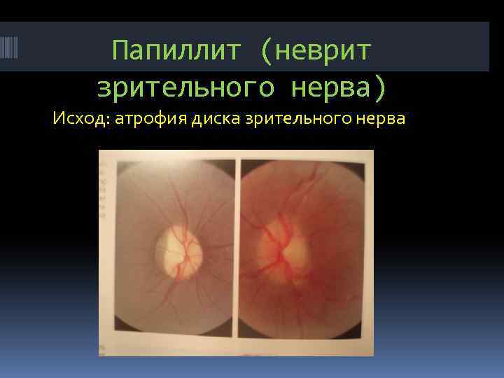 Папиллит (неврит зрительного нерва) Исход: атрофия диска зрительного нерва 