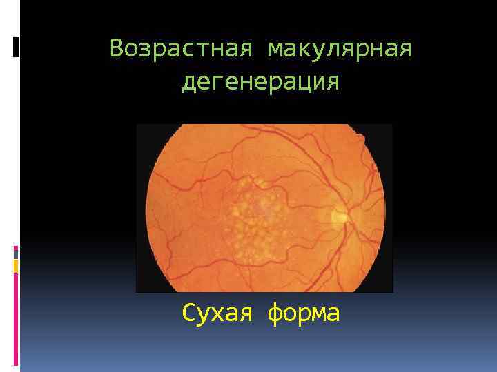 Возрастная макулярная дегенерация Сухая форма 