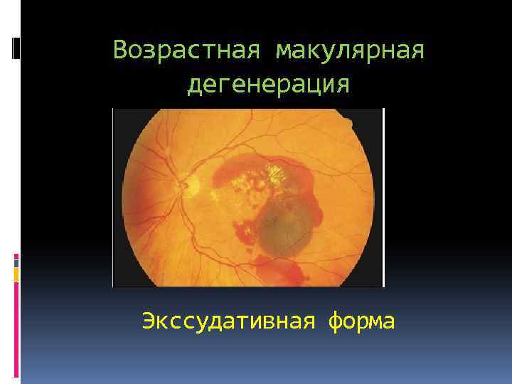 Возрастная макулярная дегенерация Экссудативная форма 