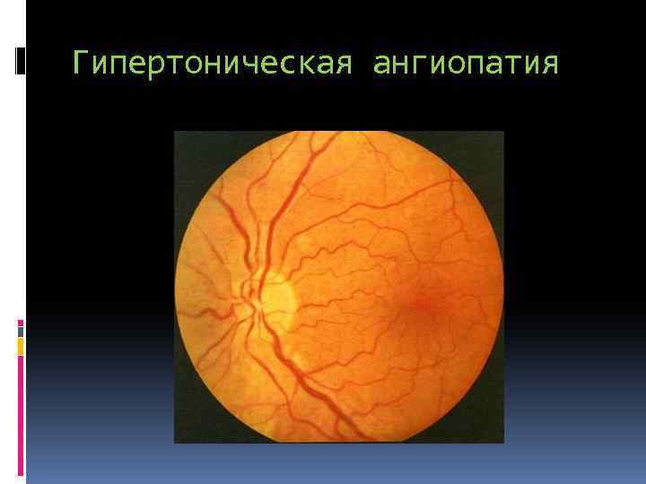 Гипертоническая ангиопатия 