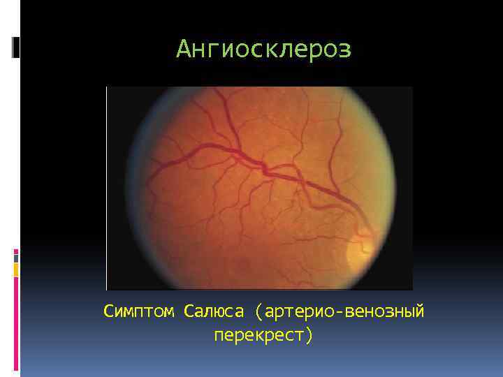 Ангиосклероз Симптом Салюса (артерио-венозный перекрест) 