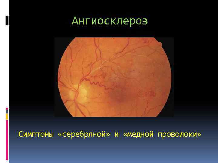 Ангиосклероз Симптомы «серебряной» и «медной проволоки» 