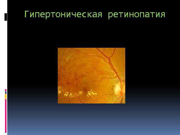 Гипертоническая ретинопатия 